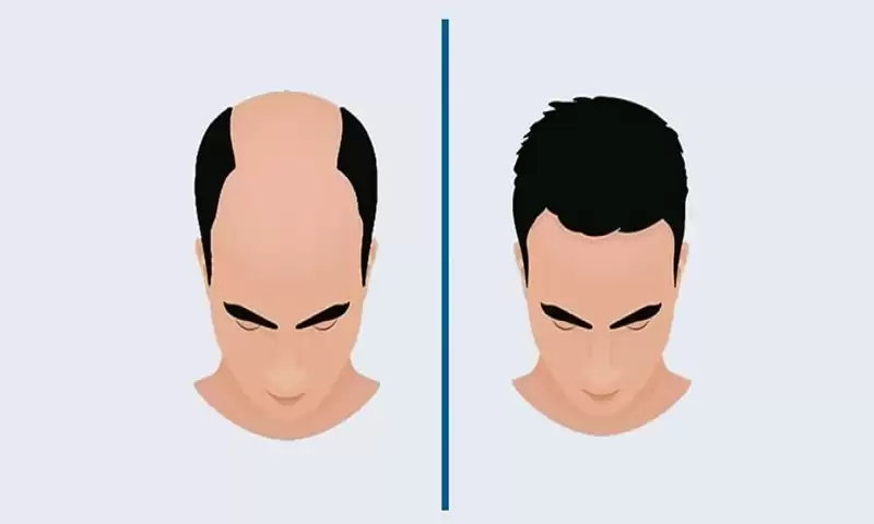 5 Quick Tips to Choose the Best Hair Transplant Clinic