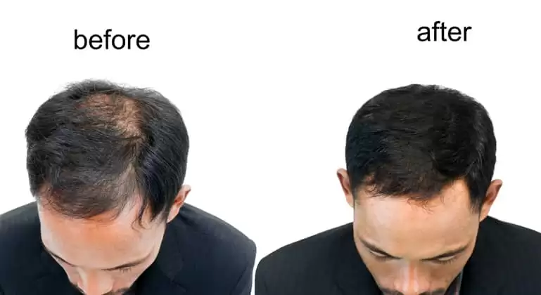 Know More About Hair Transplant That Polish Your Appearance