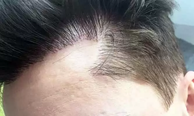 Secrets to Find the Best Hair Transplant in London